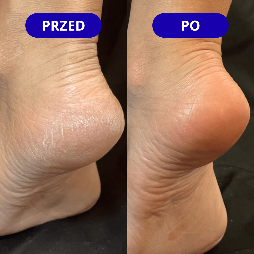 Skarpetki Pielęgnacyjne - Gładkie Stopy Po Pierwszym Użyciu