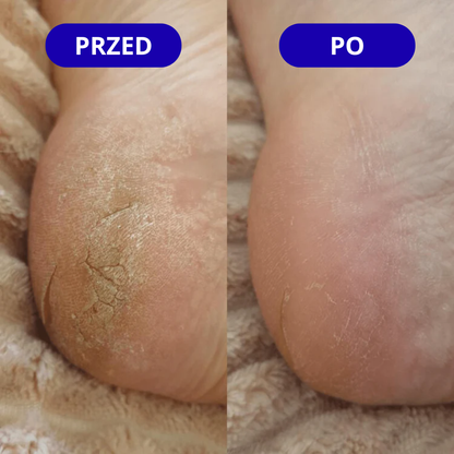 Skarpetki Pielęgnacyjne - Gładkie Stopy Po Pierwszym Użyciu